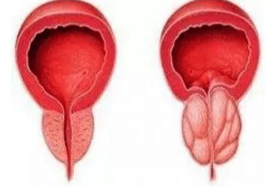 前列腺增生该如何治疗？