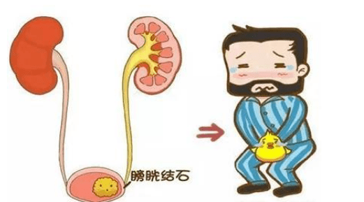 膀胱炎的早期症状是什么？(图3)