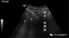 【超声随响】第25期 气性膀胱炎 “消失”的膀胱-泉州男科医院